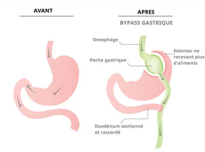 Quelle est la gravité d’une opération de bypass gastrique ?